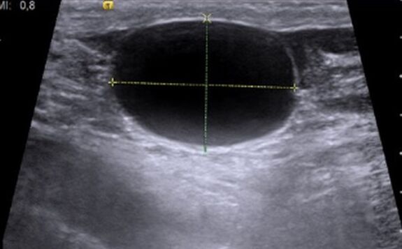 Cystonette helps cure chronic cystitis, my bladder is normal